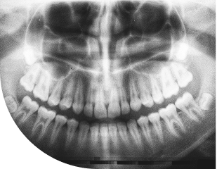 歯科医院で撮影されたパノラマレントゲン写真で、上下の歯列と顎の骨構造が一枚に写っている医療画像
